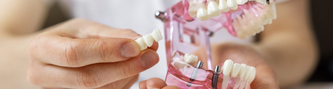 dentist implantologist showing dental bridge implant technology dentist implantologist showing dental bridge implant technology on human tooth jaw model